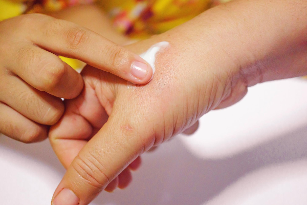 Understanding Eczema Before Treating with Fucibet Cream