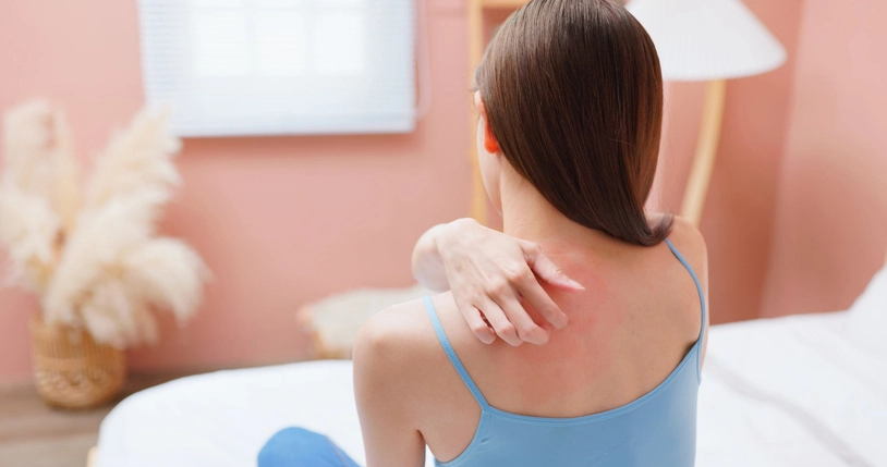 What is 'bacne' and how is it treated?