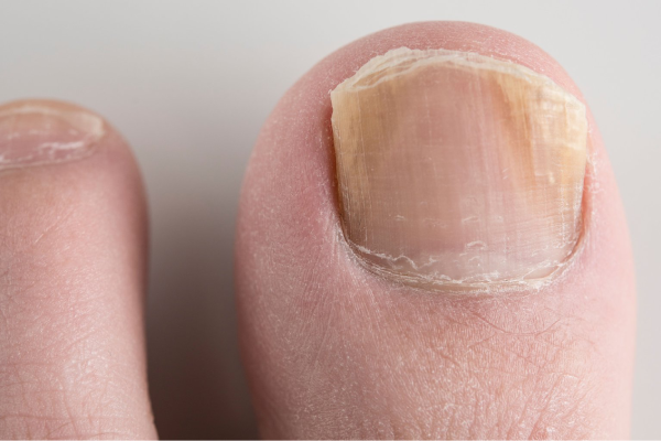 Fungal Infections