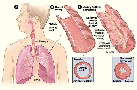 asthma attack causes