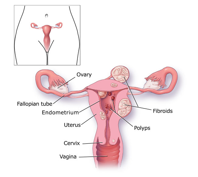 Menorragia causes diagram