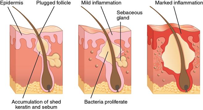 How acne develops under the skin