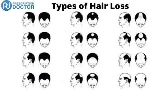 types of alopecia