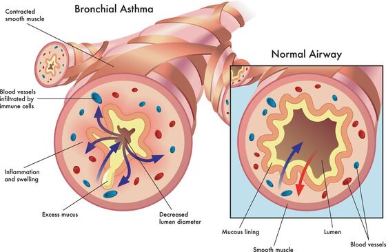 medical illustration of the effects of bronchial asthma