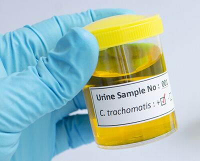 Positive chlamydia urine sample