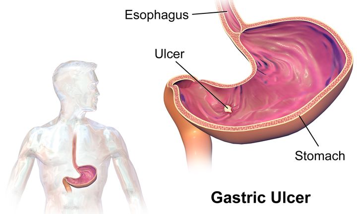 Diagram of a gastric ulcer