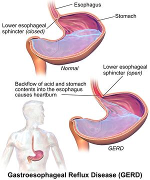 Stomach acid entering oesophagus during GERD