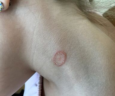 Ringworm on a woman's neck